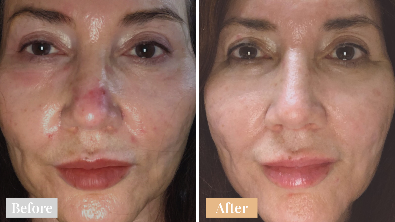 Omnilux Contour Face Mask